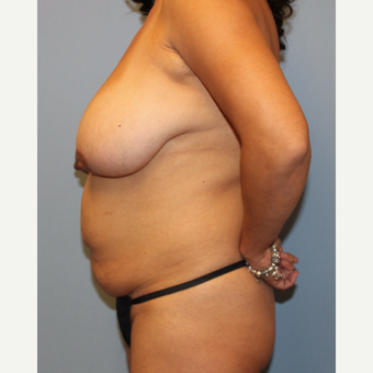 35-44 year old woman treated with Mommy Makeover before 3589454
