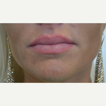 25-34 year old woman treated with Lip Augmentation before 3489900
