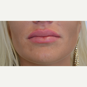 25-34 year old woman treated with Lip Augmentation after 3489900