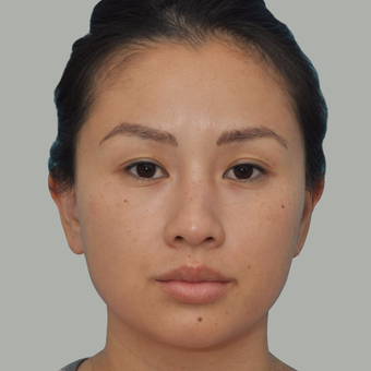 25-34 year old woman treated with Asian Rhinoplasty before 3524670