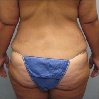37 year old woman treated with Body Lift before 3680217