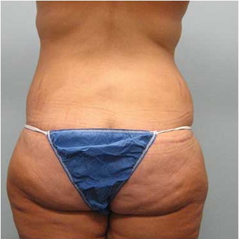 37 year old woman treated with Body Lift after 3680217