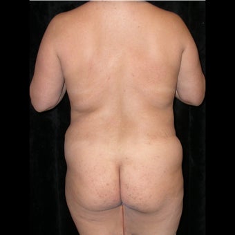 Fat Transfer to buttocks from revisional liposuction before 662280