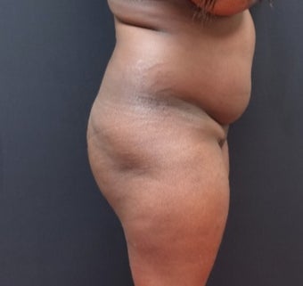 25-34 year old woman treated with Liposculpture before 3363906