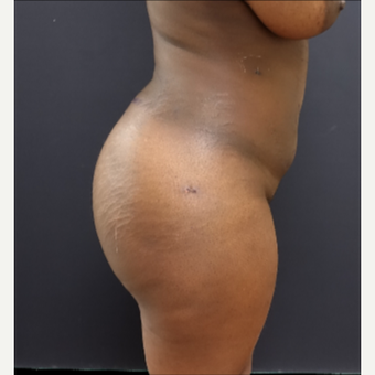 25-34 year old woman treated with Liposculpture after 3363906