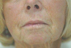 Juvederm for Smile Lines Before and After Pictures before 204767