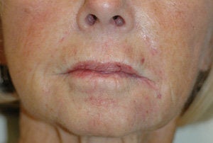Juvederm for Smile Lines Before and After Pictures after 204767