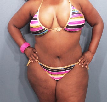 Tummy Tuck with Vaser Liposuction and butt sculpting after 2526003
