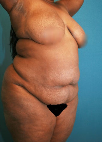 Tummy Tuck with Vaser Liposuction and butt sculpting 2526003