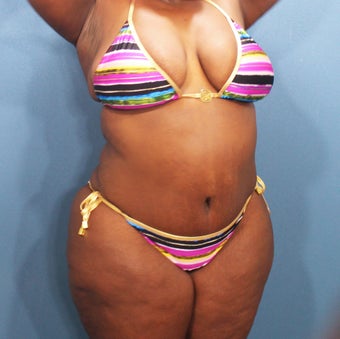 Tummy Tuck with Vaser Liposuction and butt sculpting 2526003
