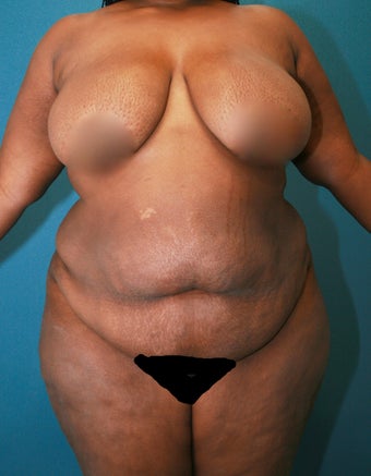 Tummy Tuck with Vaser Liposuction and butt sculpting before 2526003