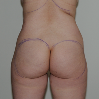 45 year old woman treated with Brazilian Butt Lift before 1662088