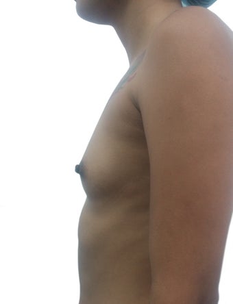 18-24 year old woman treated with Breast Augmentation 3321569