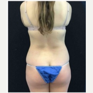 18-24 year old woman treated with CoolSculpting before 3181798