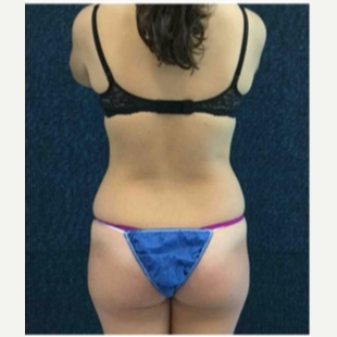 18-24 year old woman treated with CoolSculpting after 3181798