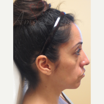 35-44 year old woman treated with Voluma in the cheeks before 3381423