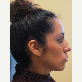 35-44 year old woman treated with Voluma in the cheeks after 3381423