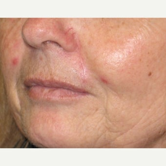 45-54 year old woman treated with Mohs Surgery after 1671142