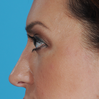 35-44 year old woman treated with Rhinoplasty after 3038287