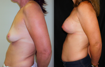 Breast Lift with Implants, Mastopexy before 1139098