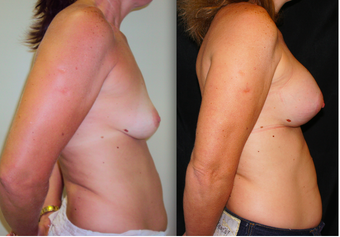 Breast Lift with Implants, Mastopexy after 1139098