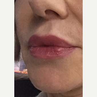 45-54 year old woman treated with Lip Lift after 2976619