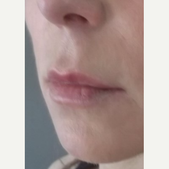 45-54 year old woman treated with Lip Lift before 2976619