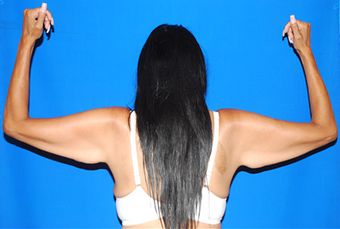 Arm Lift before 1437726
