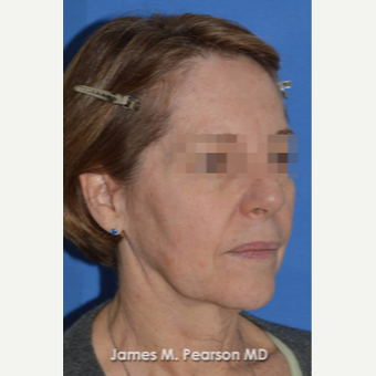 55-64 year old woman treated with Facelift before 3814870