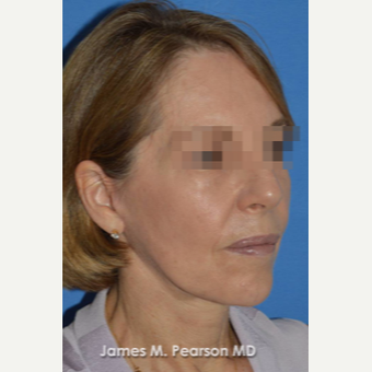 55-64 year old woman treated with Facelift after 3814870