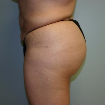 Brazilian Butt Lift after 3667408