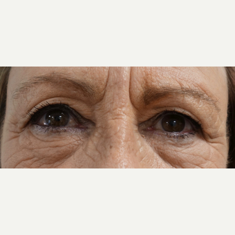65-74 year old woman treated with Eye Bags Treatment before 3493753