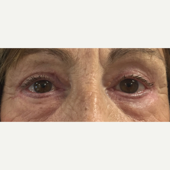 65-74 year old woman treated with Eye Bags Treatment after 3493753