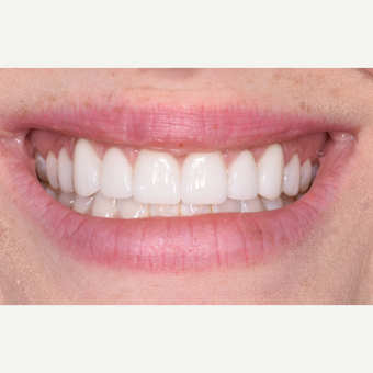 25-34 year old woman treated with Porcelain Veneers after 3732678