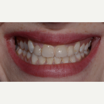 25-34 year old woman treated with Porcelain Veneers before 3732678