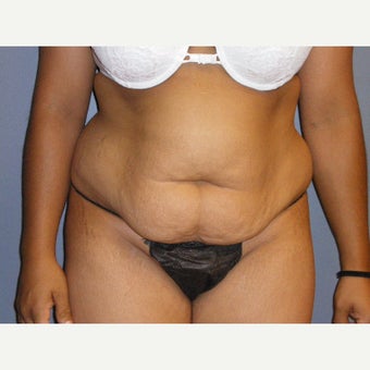 35-44 year old woman treated with Tummy Tuck, she maintained her results seven years after surgery before 1942894