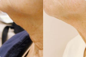 Smart Lipo: Chin Area before 989025