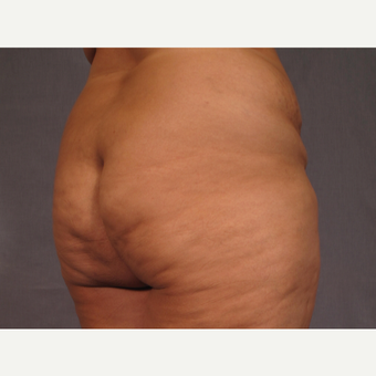 35-44 year old woman treated with Brazilian Butt Lift before 3308512