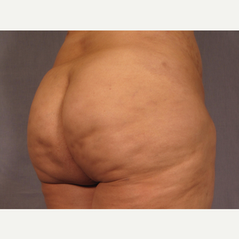 35-44 year old woman treated with Brazilian Butt Lift after 3308512