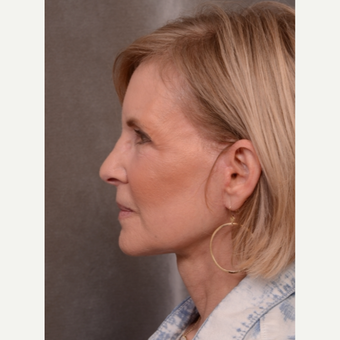 63 year old woman treated with Facelift after 3530147