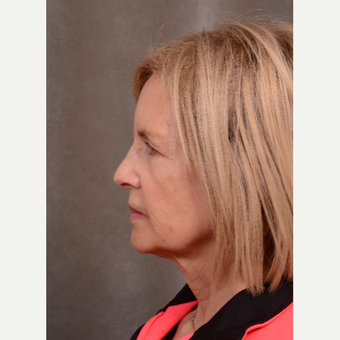 63 year old woman treated with Facelift before 3530147