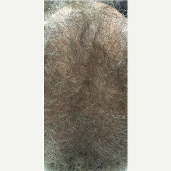 55-64 year old woman treated with PRP for Hair Loss after 3725572