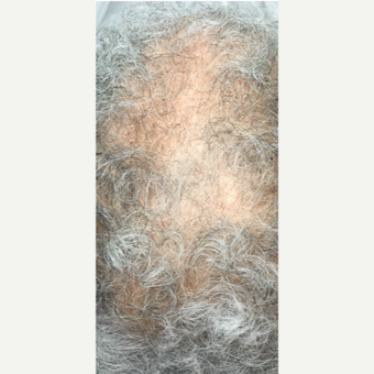 55-64 year old woman treated with PRP for Hair Loss before 3725572