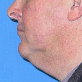 55-64 year old man treated with Neck Lift before 3497059