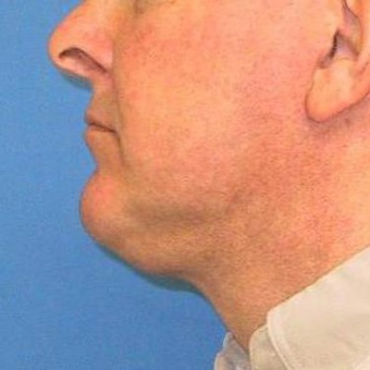 55-64 year old man treated with Neck Lift after 3497059
