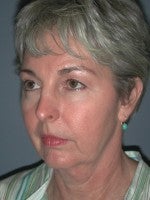 65-74 year old woman treated with Neck Lift before 3103895
