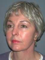 65-74 year old woman treated with Neck Lift after 3103895