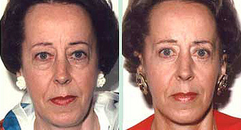 Lower-Lid Blepharoplasty before 1353993