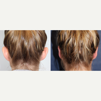 23 year-old female before and one 3 months after Ear Surgery (Otoplasty) before 3441467