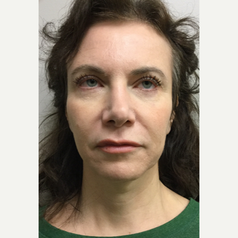 45-54 year old woman treated with Mini Facelift with Neck Liposuction and Chin Implant before 3371353